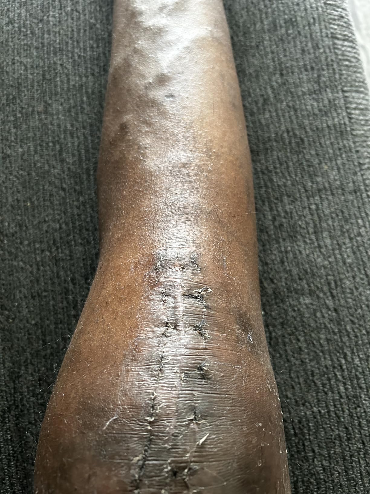 Knee Replacement Recovery Aids, Ice Machine Knee Surgery Recovery Equipment, Physical Therapy Equipment customer photo 1